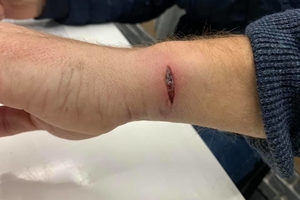 Новини Вінниці / У Вінниці відмовили у запобіжному заході для атовця-інваліда, який нібито вдарив поліцейського