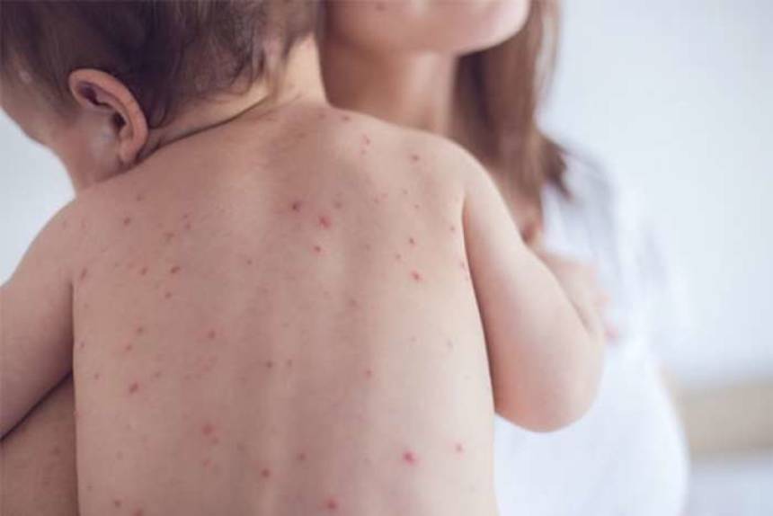 Новини Вінниці / Де на Вінниччині найбільше людей хворих на кір