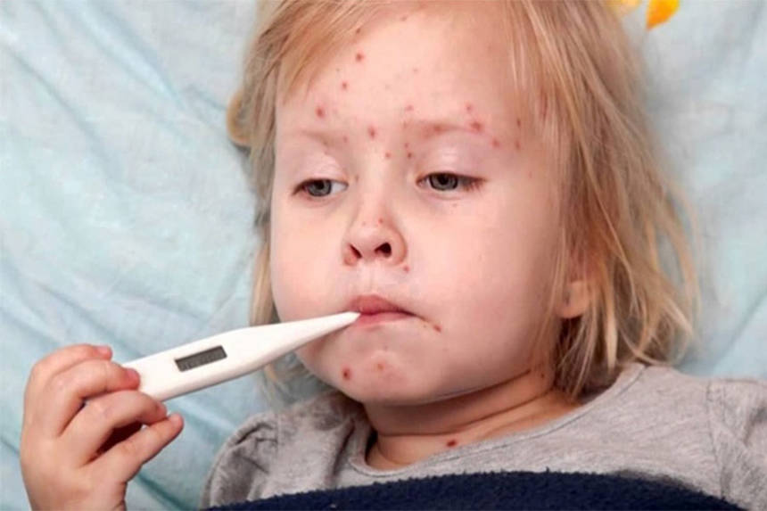 Новини Вінниці / Дві смерті від кору на Вінниччині. Що варто знати про недугу?