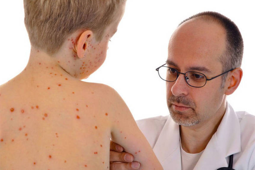 Новини Вінниці / Чи вщухає епідемія? На Вінниччині реєструють менше захворілих на кір