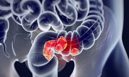 Новини Вінниці / Колоректальний рак у разі раннього виявлення добре піддається лікуванню