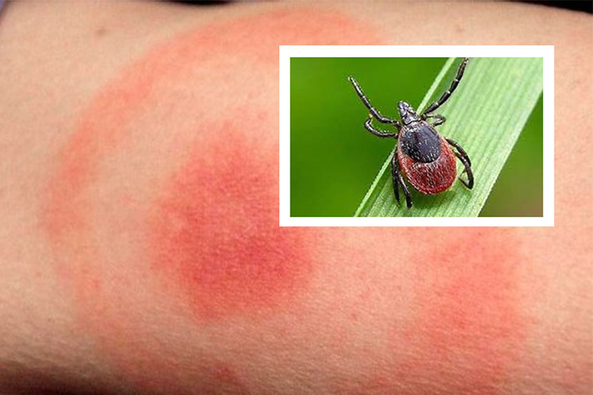 Новини Вінниці / Коли знайшли на тілі кліща? Вінничанам радять перевіритись на хворобу Лайма