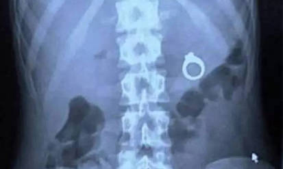 Новини Вінниці / Обручка у шлунку: через освічення вінничанка опинилась у лікарні 